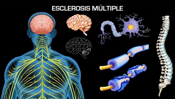 Esclerosis múltiple… “seguimos diagnosticando tarde”