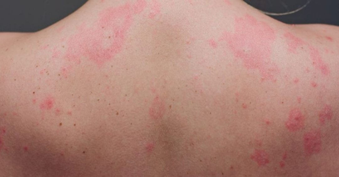 síntomas en la piel de la COVID-19